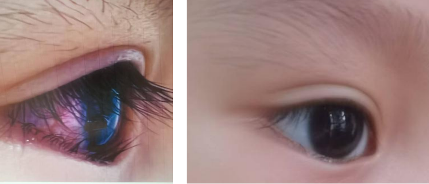 十周年 我与华厦的故事：深圳华厦眼科医院成功救治各类眼外伤患者，专业实力守护视力健康