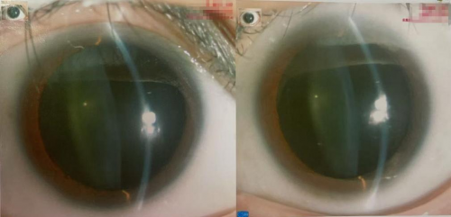 十周年 我与华厦的故事：香港患者在深圳华厦重获清晰视力